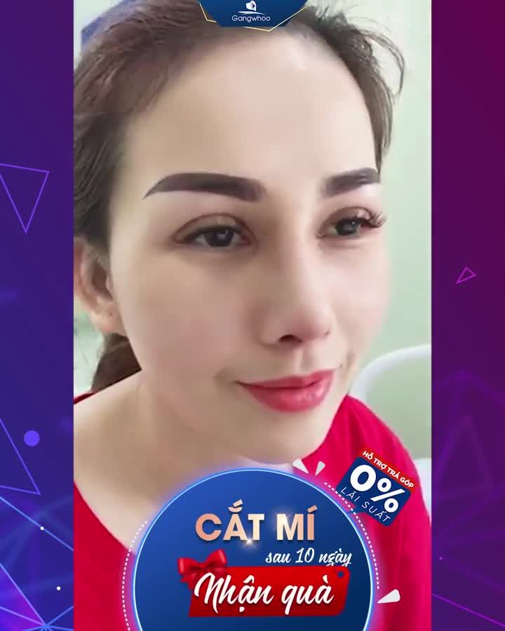 CẮT MẮT HAI MÍ - CHO ĐÔI MẮT TRẺ ĐẸP ĐÔI MƯƠI
