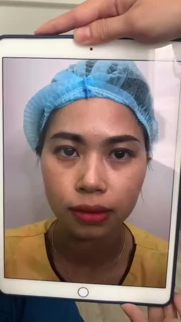 CẮT MÍ - CƠ SỞ HCM Sau 7 ngày thực hiện cắt mí tại Dr.Hải Lê cơ sở HCM