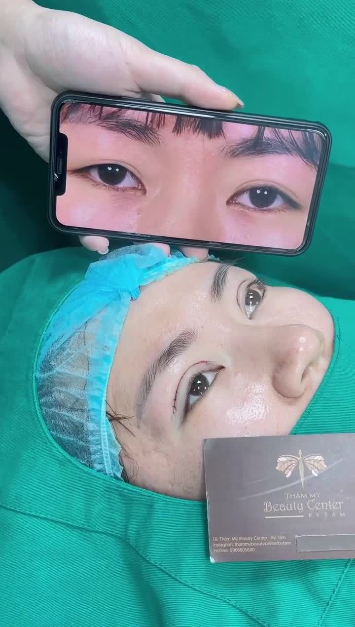 Cắt mí để có đôi mắt to tròn, thu hút hơn. Khách hàng 28 tuổi bị sụp mí, mỡ mắt nhiều đã được bác sĩ thăm khám và tư vấn dịch vụ cắt mí Line Mini.
