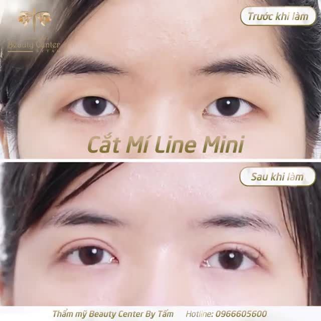 Cắt mí Line Mini - Giải pháp giúp đôi mắt đẹp long lanh được khách hàng tin tưởng lựa chọn.