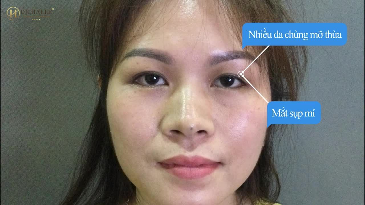 "Cắt mí xong chỉ hơi căng căng 1 chút thôi, không có cảm giác đau gì đâu... "