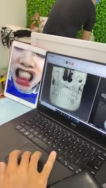 CẤY GHÉP 4 TRỤ IMPLANT 1 LÚC SẼ NHƯ THẾ NÀO