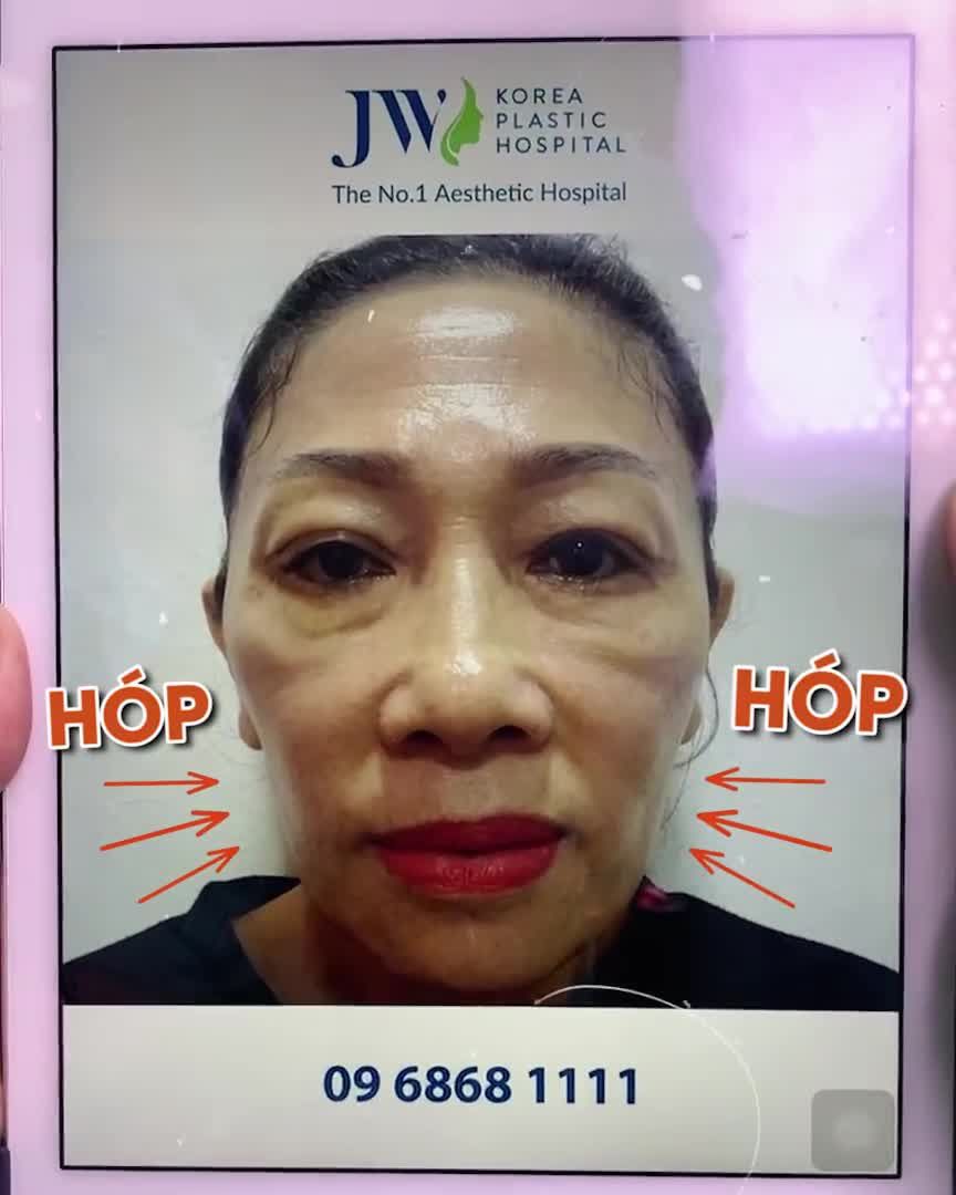 Cấy mỡ mặt BABY FACE - Đánh đuổi LÃO HÓA, Giữ hoài THANH XUÂN