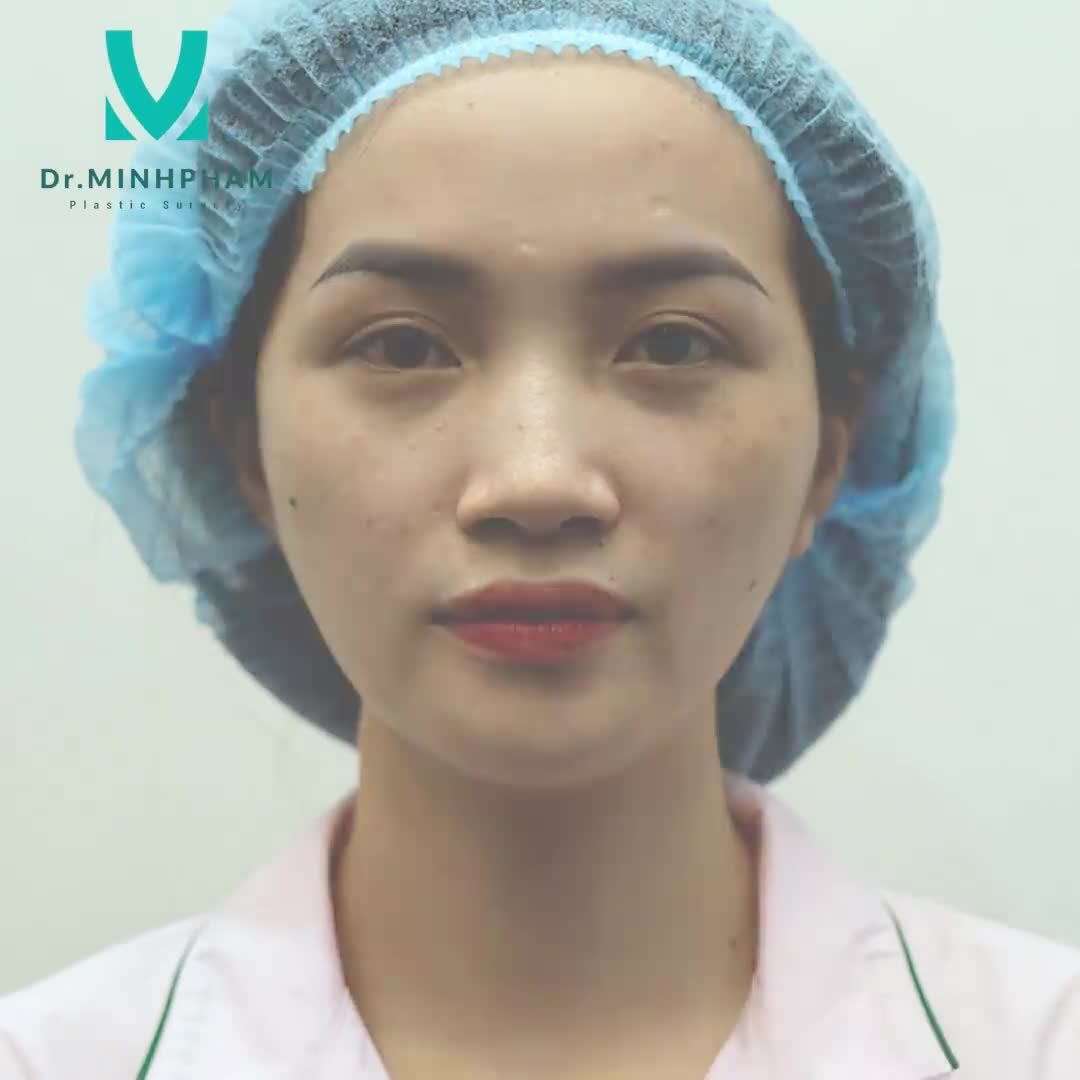 CẤY MỠ MẶT MIỄN PHÍ HÚT MỠ BỤNG ĐẸP ĐƠN ĐẸP KÉP VỚI BỤNG LÉP MẶT XINH.