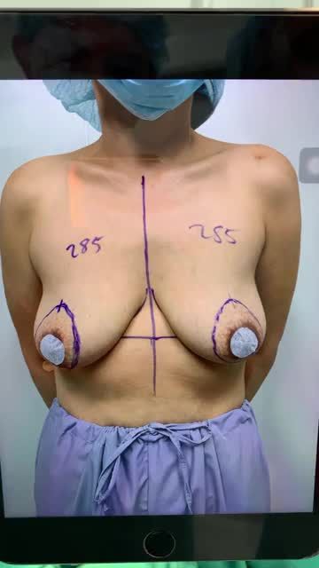 CHIA SẺ HÌNH ẢNH DÁNG NGỰC NGAY SAU PHẪU THUẬT