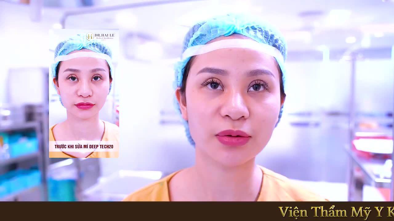 Chia sẻ về cuộc sống và tinh thần sau khi thẩm mỹ mắt thất bại và có thêm kinh nghiệm sửa lại mí hỏng bạn nhé!