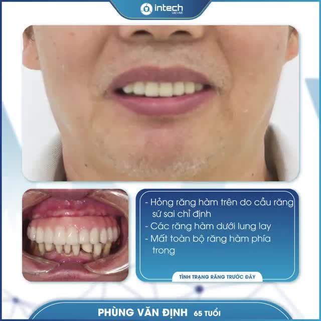 CHIÊM NGƯỠNG MỘT CA TRỒNG RĂNG IMPLANT TOÀN HÀM TRÊN THÀNH CÔNG TẠI NHA KHOA LẠC VIỆT INTECH