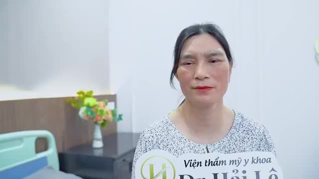 Chiêm ngưỡng ngay "tác phẩm" sau Sửa mí của chị khách hàng dưới đây để cùng chứng thực về tính ưu Việt của công nghệ sửa mí Deep Tech20 tại VTM Dr.Hải Lê!