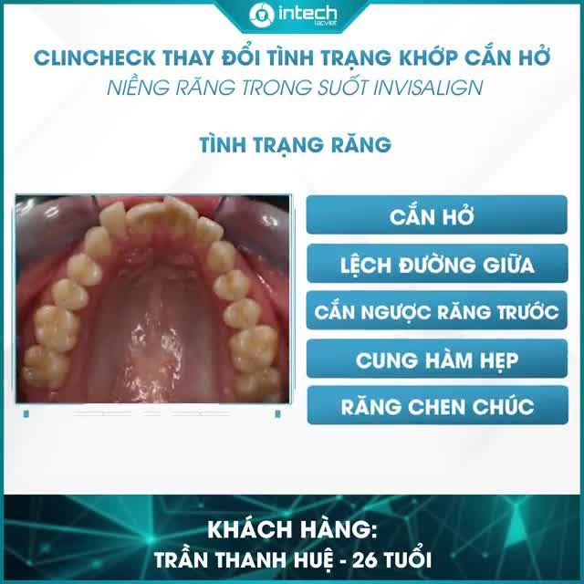 CLINCHECK NIỀNG RĂNG INVISALIGN- KHÁCH HÀNG GẶP TÌNH TRẠNG KHỚP CẮN HỞ