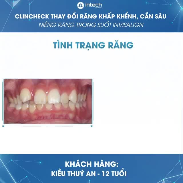 CLINCHECK NIỀNG RĂNG INVISALIGN- QUÁ TRÌNH THAY ĐỔI TRÊN RĂNG KHẤP KHỂNH, CẮN SÂU