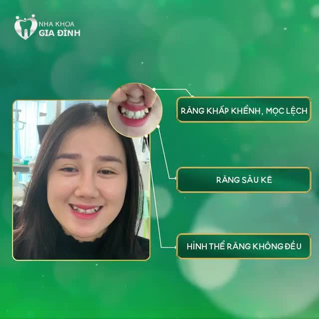 CÓ ĐƯỢC HÀM RĂNG TRẮNG ĐẸP, NỤ CƯỜI RẠNG NGỜI NHƯ NGÀY HÔM NAY TẤT CẢ LÀ NHỜ NHA KHOA GIA ĐÌNH
