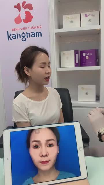 Cô gái má hóp, thái dương lõm đã được hồi sinh sau khi làm DV Cấy mỡ tại Bvtm Kangnam
