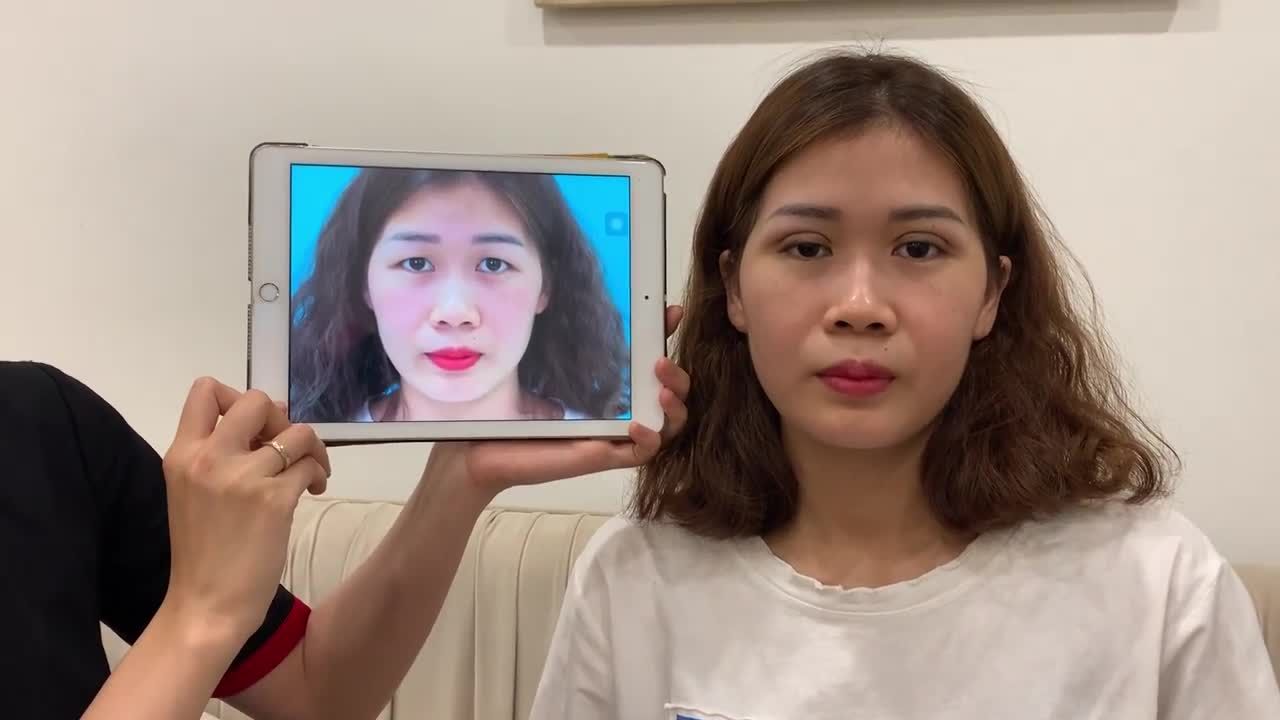 Combo lấy mỡ mí mắt + Nhấn mí Oval Line Wide Deep của khách hàng sau 60 phút.