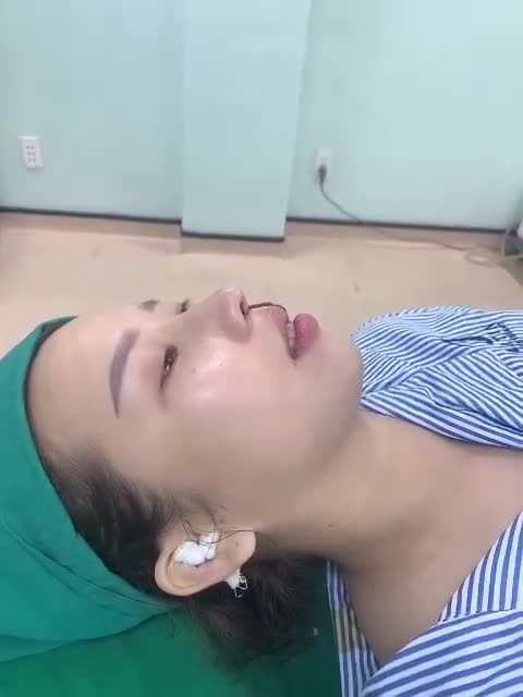 Combo mũi cấu trúc sóng Surgiform + độn cằm sụn Mỹ