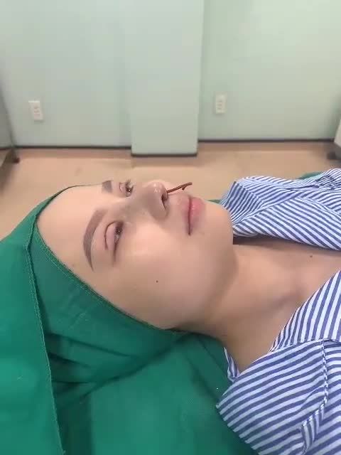 Combo Mũi cấu trúc Surgiform + Mí 4D ngay sau phẫu thuật cho bạn gái từ Hậu Giang lên Sài Gòn làm đẹp.