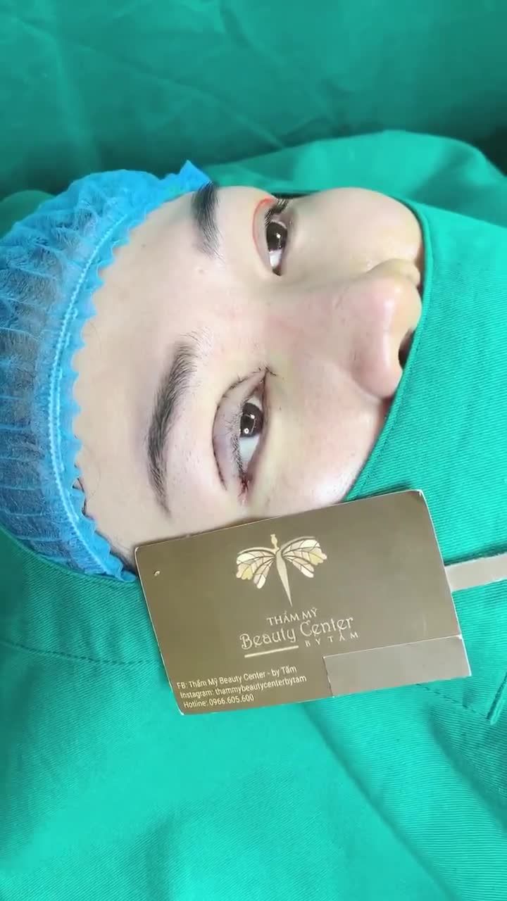 Combo Perfect Eyes tại trung tâm: cắt mí - mở 2 góc mắt.