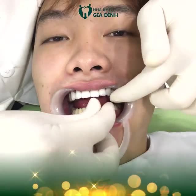 CÔNG KHAI VIDEO ƯỚM THỬ VENEER SỨ LÊN RĂNG CHO DIỄN VIÊN TRỌNG LÂN