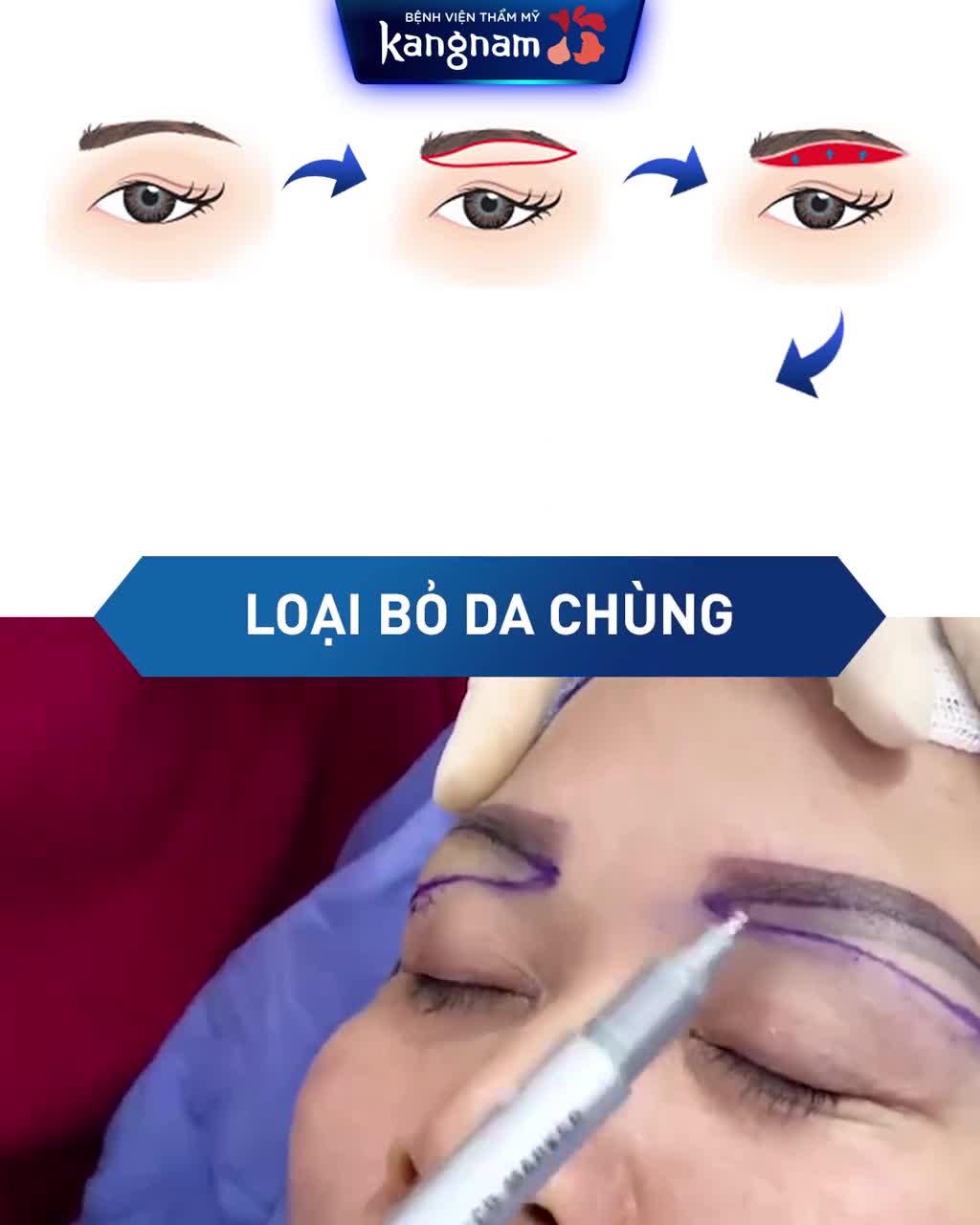 DA CHÙNG gây SỤP MÍ, SỆ ĐUÔI MÀY?