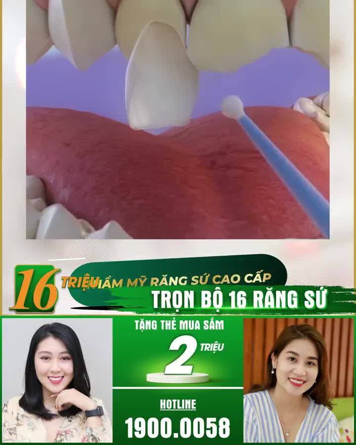 Dán sứ Veneer - Bảo tồn răng thật - Bảo hành trọn đời