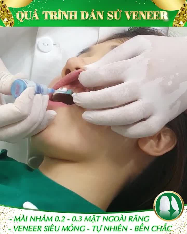 DÁN SỨ VENEER - LÀM TẠI NHA KHOA GIA ĐÌNH NHẤT ĐỊNH PHẢI ĐẸP