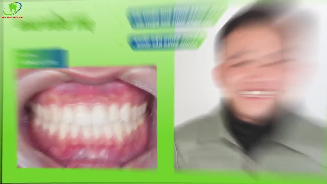 ĐÁNH BAY RĂNG THƯA - TÌM LẠI NỤ CƯỜI TỰ TIN VỚI DÁN SỨ VENEER