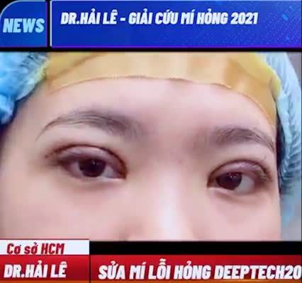 ĐÂY LÀ TÔI - TRƯỚC VÀ SAU KHI SỬA MÍ TẠI DR.HẢI LÊ CƠ SỞ HCM
