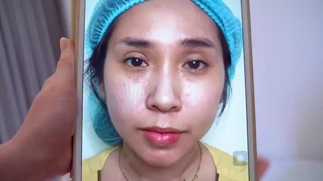 Dr.Hải Lê cơ sở HCM Tiếp tục giải cứu thành công ca mí lỗi hỏng do thực hiện tại cơ sở thiếu uy tín