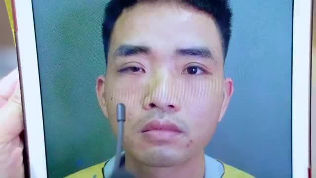Dr.Hải Lê tiếp nhận khắc phục ca mí mắt Đứt cơ mi cho vị khách nam giới sau cắt mí tại cơ sở không uy tín dẫn đến liệt cơ nâng mi