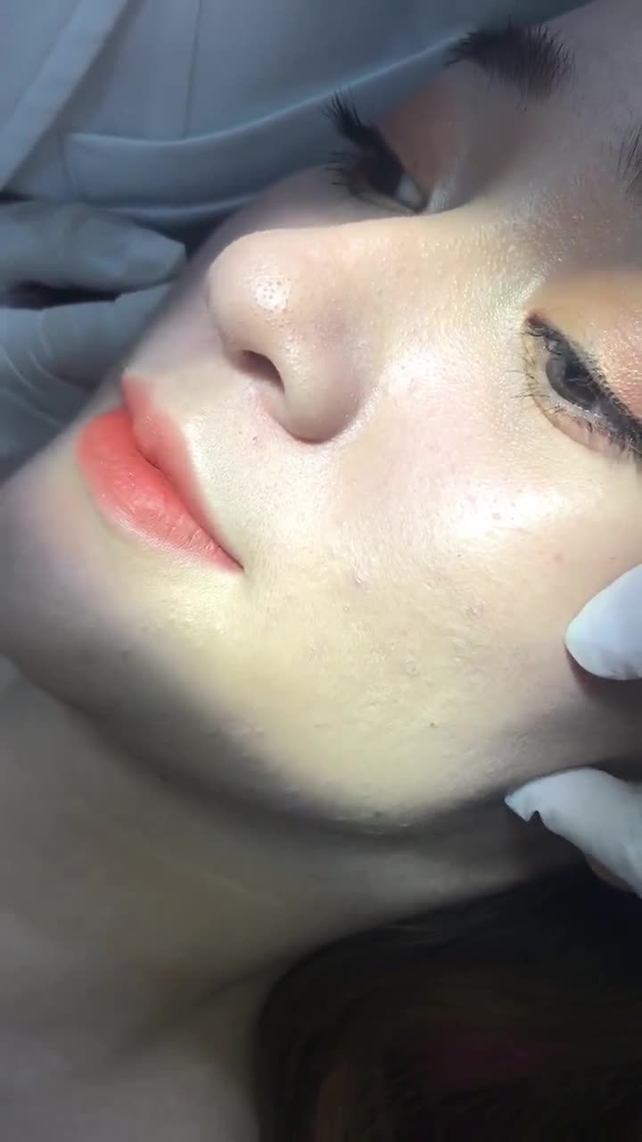 Filler má baby cho khách hàng má hóp khiến gưing mặt bị hốc hác, đứng tuổi.