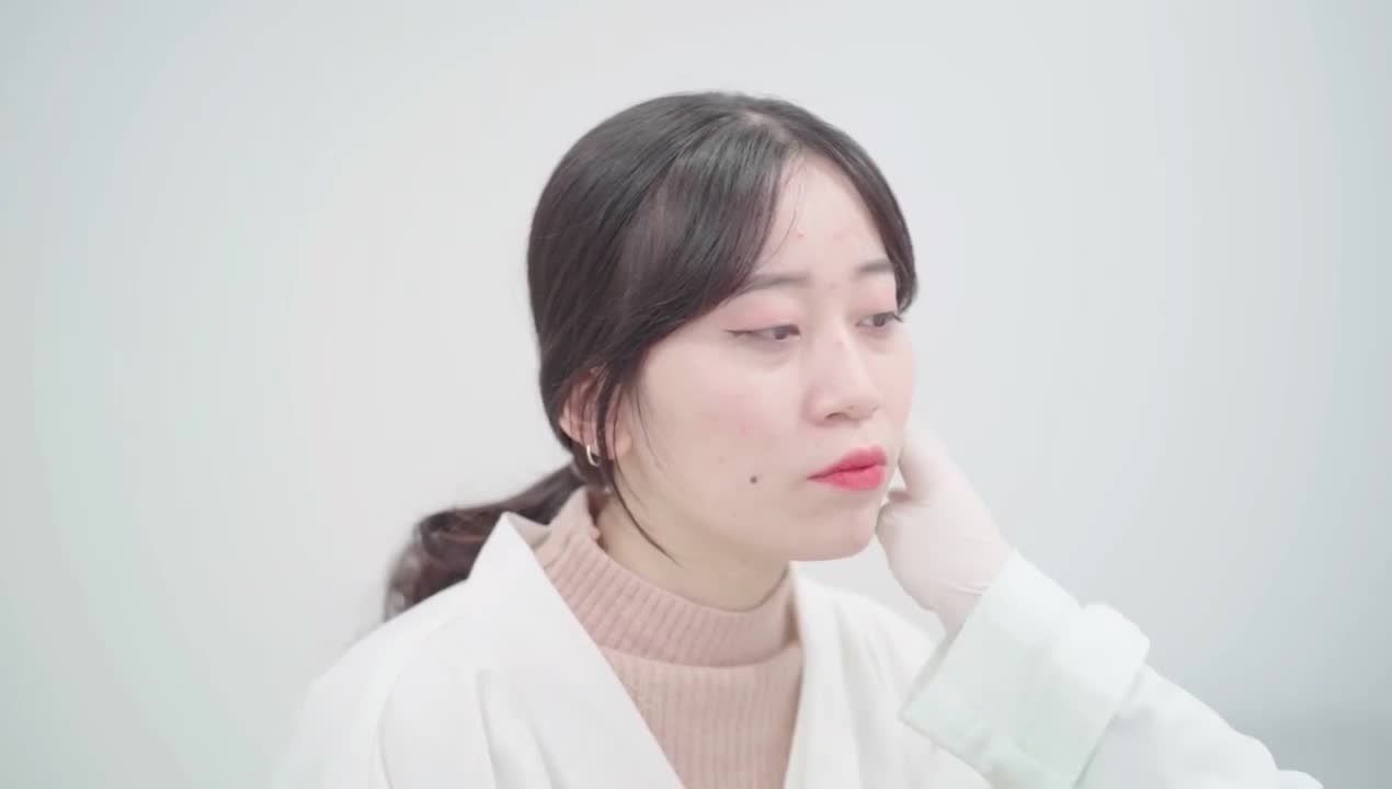 Filler má mang lại vẻ ngoài tươi tắn và trẻ trung hơn cho khách hàng má hóp nhiều do nhổ răng và niềng răng.