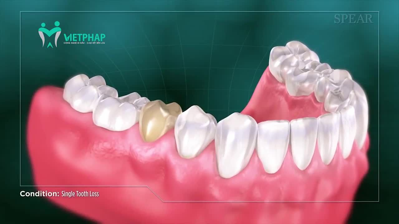 HẬU QUẢ CỦA VIỆC MẤT RĂNG LÂU NGÀY