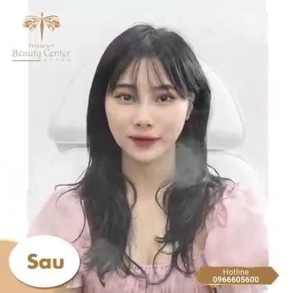 Hình ảnh thực tế khách hàng làm BOTOX THON GỌN HÀM tại Thẩm mỹ Beauty Center by Tấm sau 2 tháng.