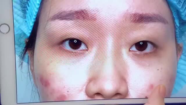Hô biến mắt 1 mí trở thành 2 mí chỉ sau 45 phút thực hiện tiểu phẫu Cắt mí+ mở góc mắt Mời quý khách hàng cùng theo dõi
