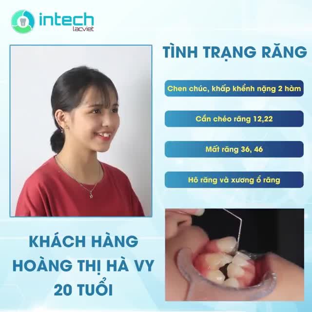 HOÀN THIỆN NHAN SẮC SAU KHI NIỀNG RĂNG TẠI NHA KHOA LẠC VIỆT INTECH