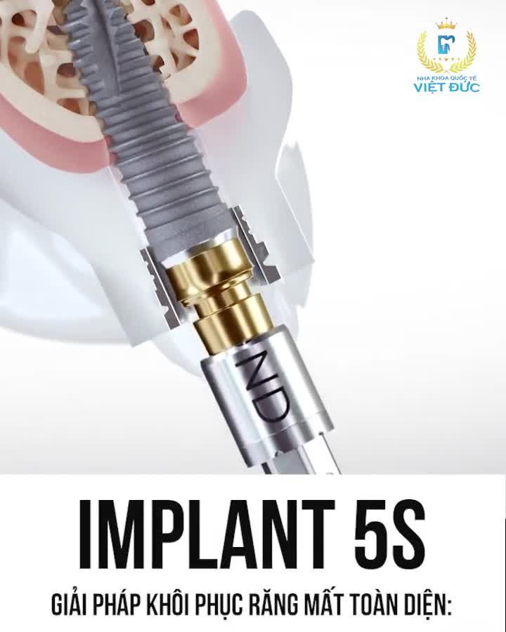 Implant 5S Giải pháp khôi phục mọi trường hợp mất răng một cách toàn diện