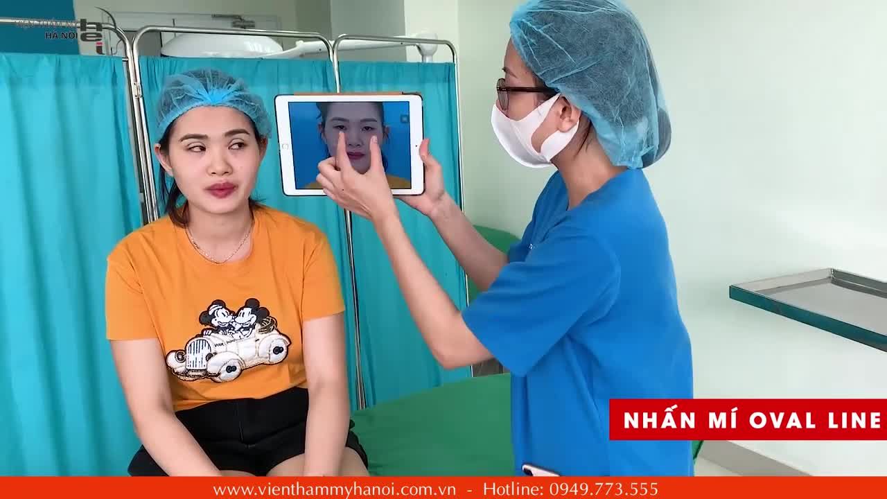 Kết quả khách hàng sau khi Nhấn mí Oval Line - kỹ thuật độc quyền tại Viện thẩm mỹ Hà Nội.