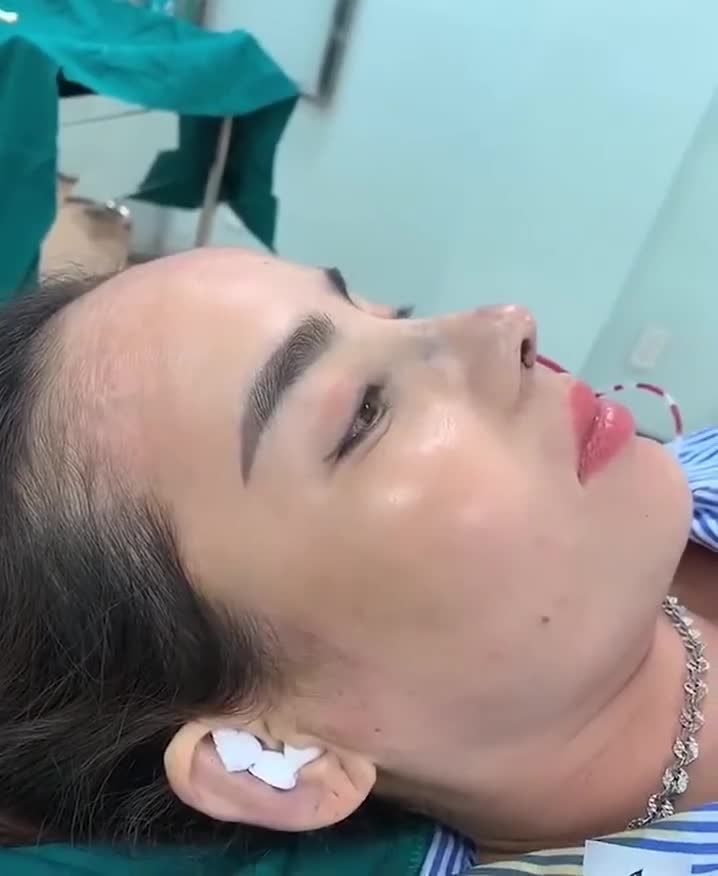 Kết quả mũi cấu trúc sửa lại cho chị KH đến từ Bình Phước.