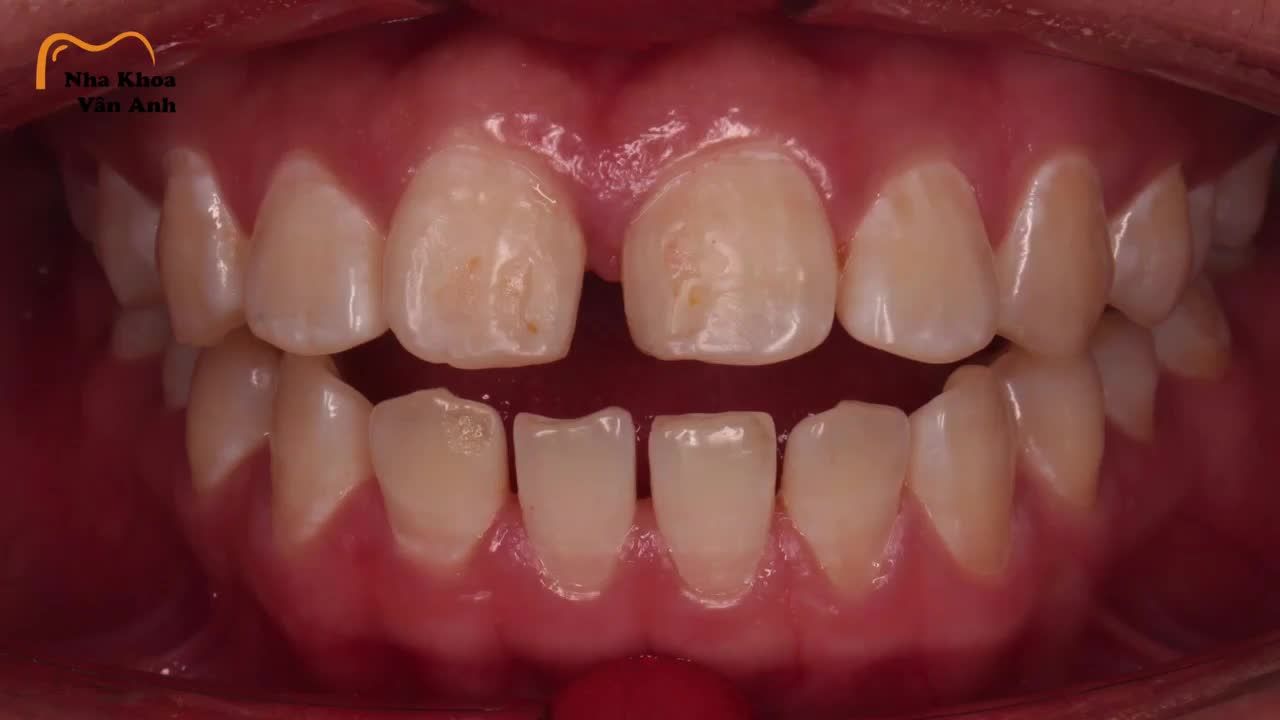 KẾT THÚC HÀNH TRÌNH NIỀNG RĂNG BẰNG MỘT NỤ CƯỜI TỰ TIN