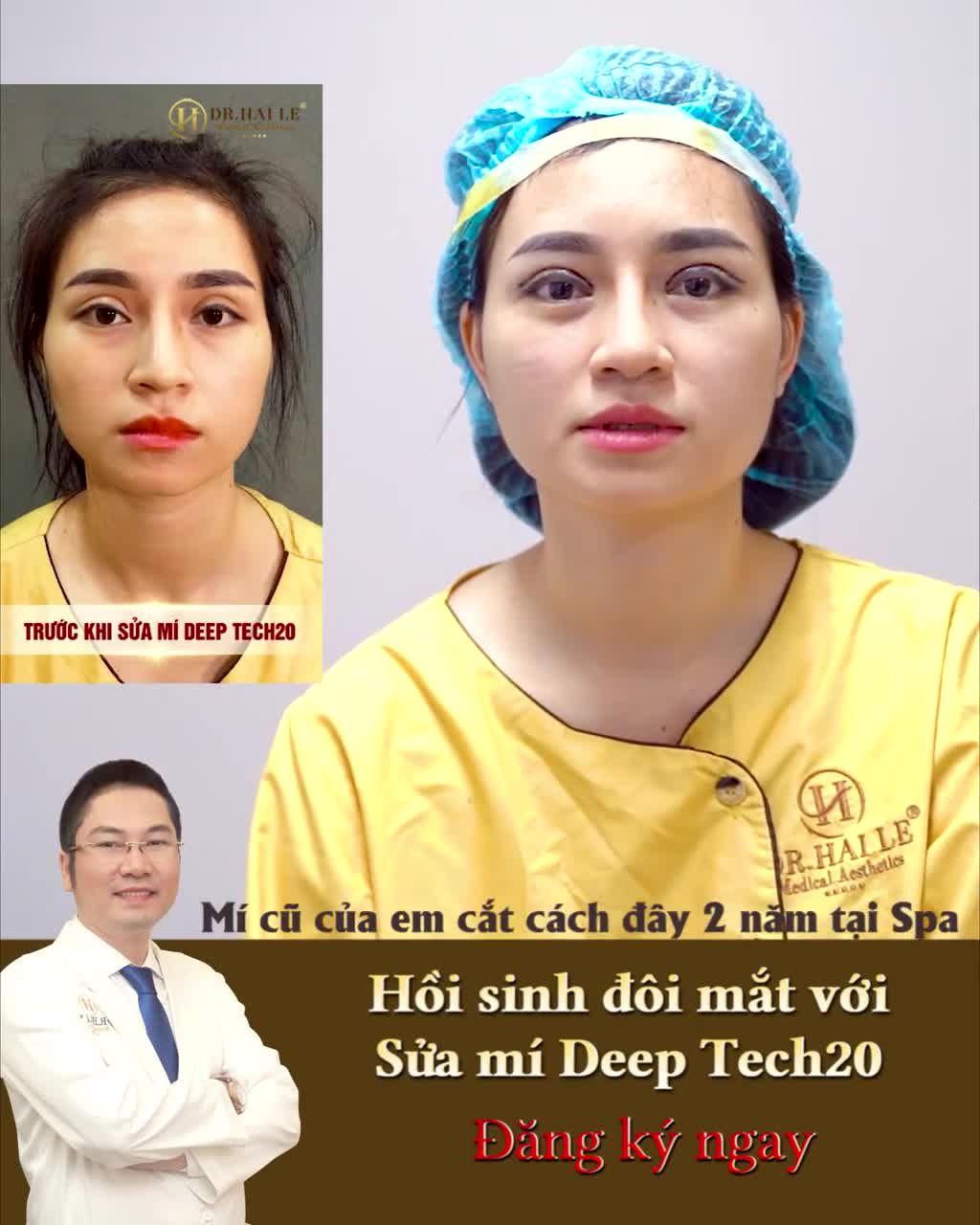 KH N.T.N (Quảng Ninh) chia sẻ: Cắt mí