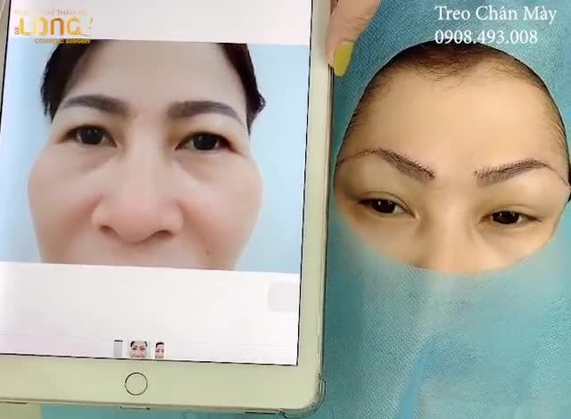 KHẮC PHỤC LÃO HÓA TÌM LẠI ÁNH NHÌN TƯƠI TRẺ CHO ĐÔI MẮT