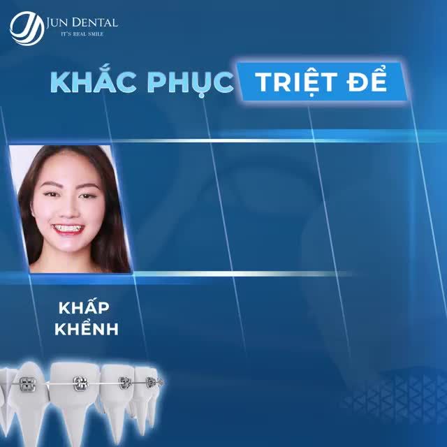 KHẮC PHỤC TRIỆT ĐỂ HÔ, MÓM, KHẤP KHỂNH, KHỚP CẮN SÂU