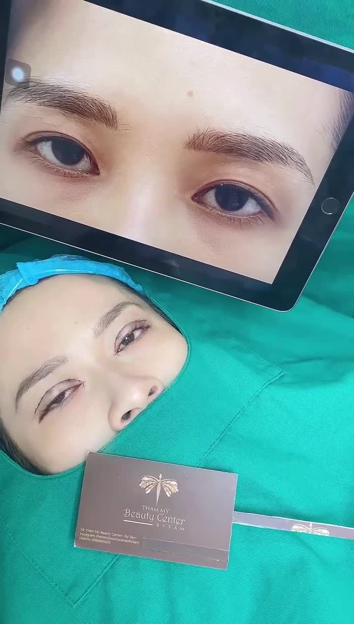 Khách hàng cắt mí mở góc mắt thay đổi hoàn toàn ngay sau khi vừa phẫu thuật.