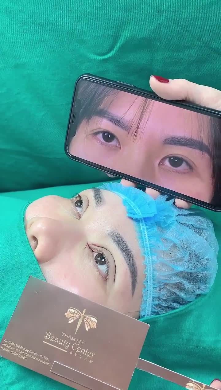 Khách hàng cắt mí- mở góc trong để có đôi mắt to và thu hút hơn.