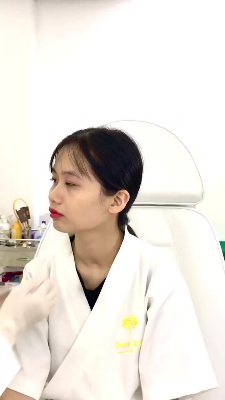 Khách hàng đến thăm khám và làm dịch vụ Botox thon gọn hàm.