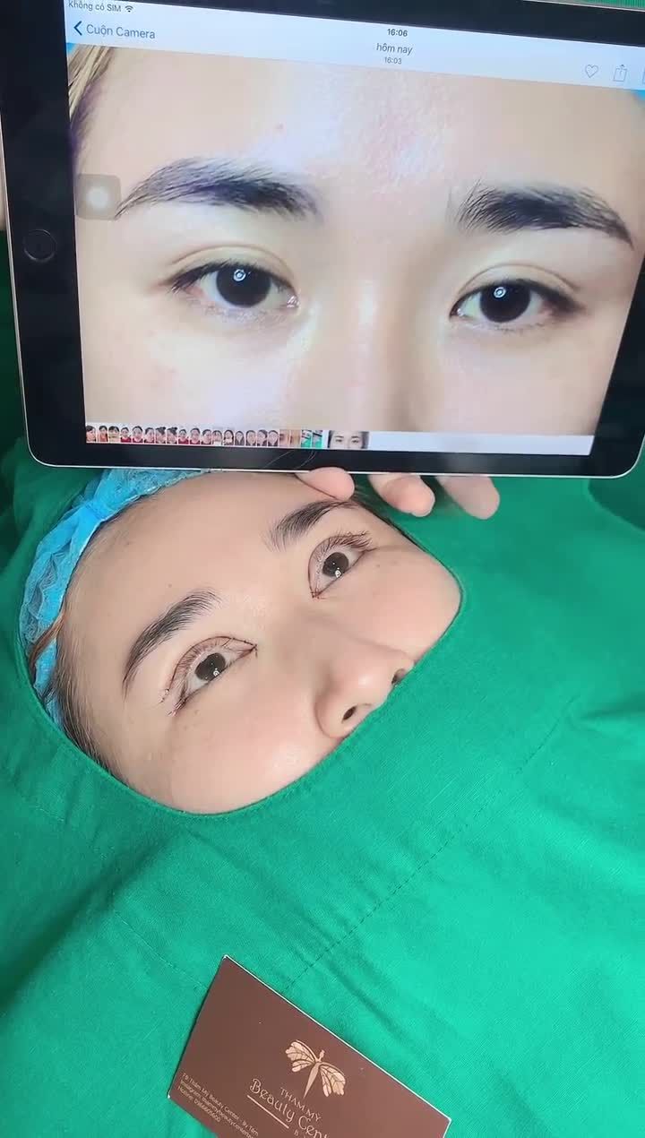 Khách hàng làm combo cắt mí, mở góc trong - ngoài. Khách từng mở góc trong ở cơ sở khác nhưng bị lỗi, góc trong tù, cụp bị dẻ quạt nên đã qua Tấm để sửa lại. Vừa làm xong đã khác biệt rõ rệt.