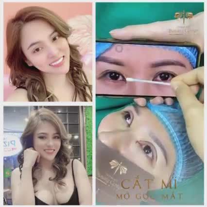 Khách hàng làm Perfect Eyes tại Thẩm mỹ Beauty Center by Tấm để có đôi mắt to tròn, long lanh và hút hồn.