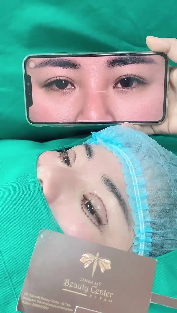 Khách hàng lặn lội từ Lạng Sơn lên Hà Nội để cắt Mí mắt trên và mí dưới tại Tấm.