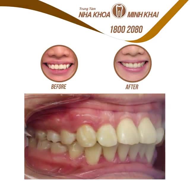 Khách hàng nữ sinh năm 1990, đến với Nha Khoa Minh Khai với mong muốn điều chỉnh răng đều.