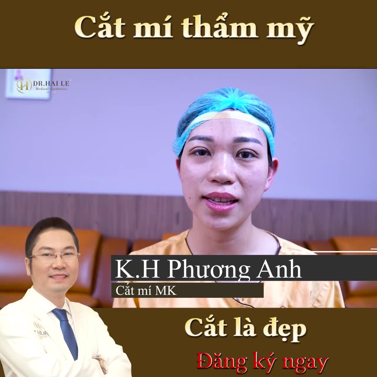 Khách hàng Phương Anh (Đông Anh - HN) chia sẻ: "30 năm mắt 1 mí, giờ mắt 2 mí không quen lắm, nhưng thấy đẹp hơn là ưng rồi, biết thế này làm sớm hơn rồi"