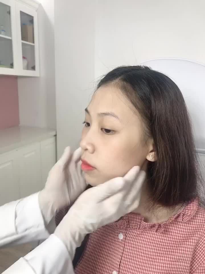 Khách hàng qua kiểm tra Vline Perfect và quyết định làm Filler cằm để có ngoại hình thu hút hơn!